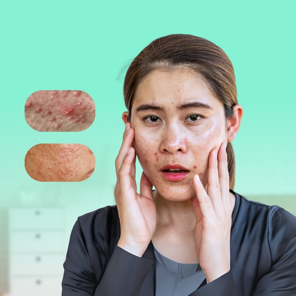 cara menghilangkan bekas jerawat